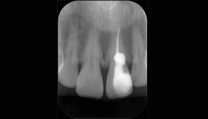 歯冠部の封鎖