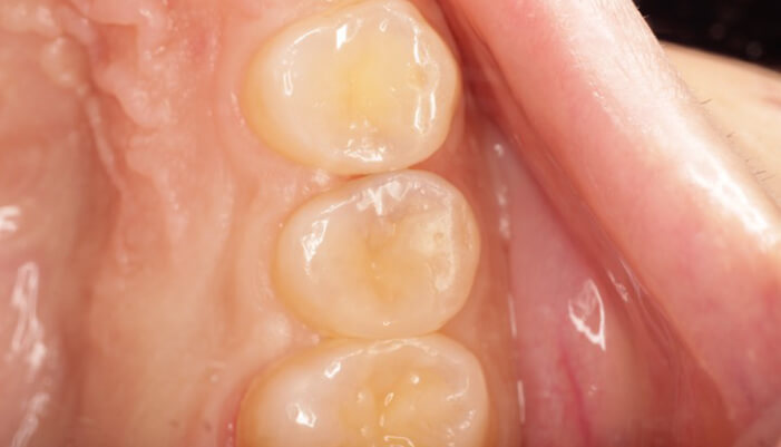 虫歯の治療:精密修復治療