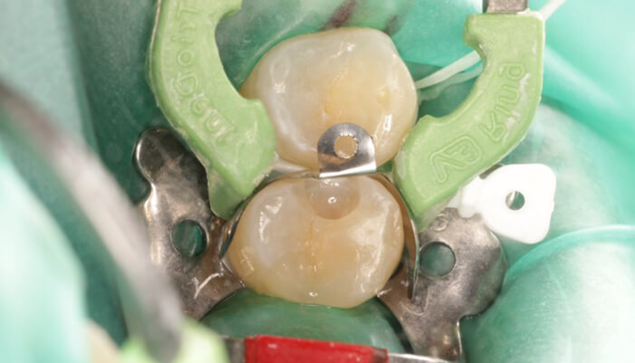 歯の隣り合った面の形態を再現する道具