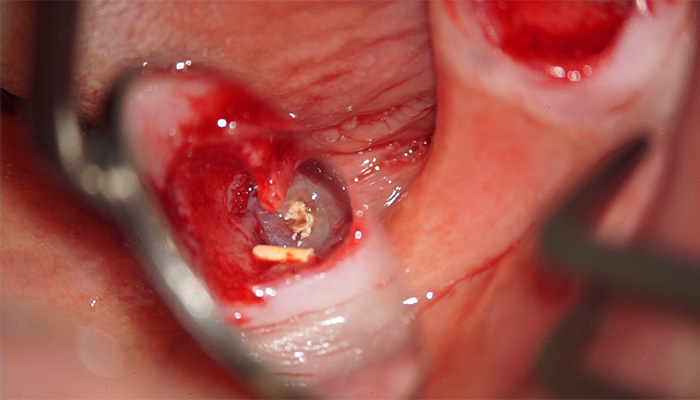 抜歯窩をマイクロスコープで確認