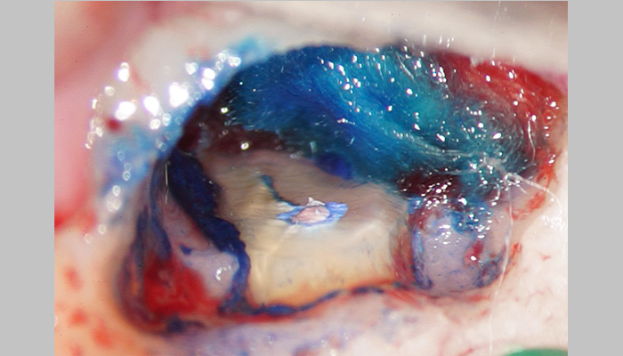 歯根端切除した歯根の断面