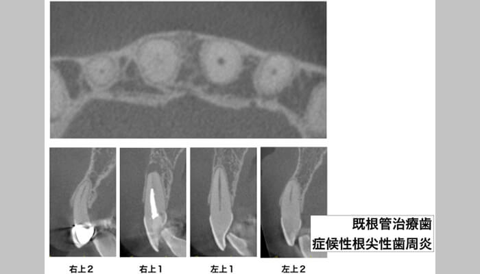 外科的根管治