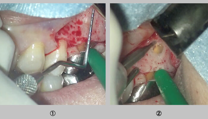 切開、歯肉剥離