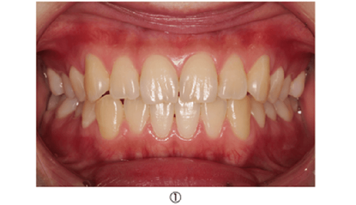上顎前歯部隣接面の虫歯の治療:精密修復治療直接法時の術前口腔内写真