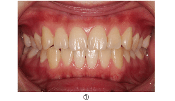 上顎前歯部隣接面の精密修復治療直接法時の術前口腔内写真