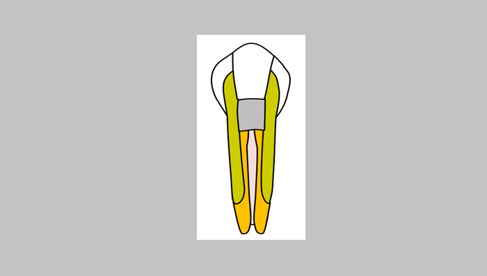 下顎右側第二小臼歯の咬合面に認められる、中心結節が折れた痕跡