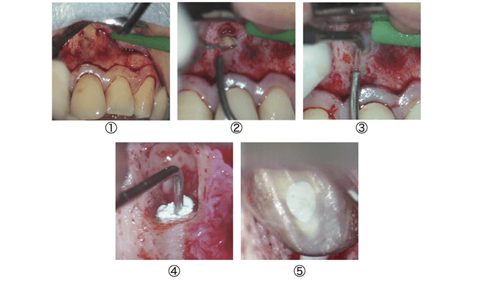 外科的根管治療中の歯根の切断面