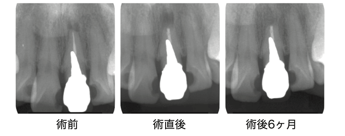 術後６ヶ月で治癒