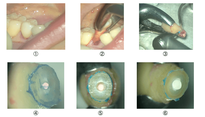 意図的再植術下での歯根端切除＋逆根管充填