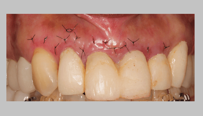 上顎右側中切歯に対して行われた外科的根管治療　術後４日で、抜糸の際の写真