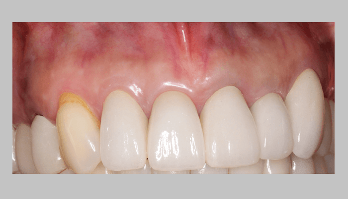 外科的根管治療 | 東京の歯内療法・根管治療専門 | 高林デンタル 